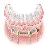 имплантация зубов в Куркино