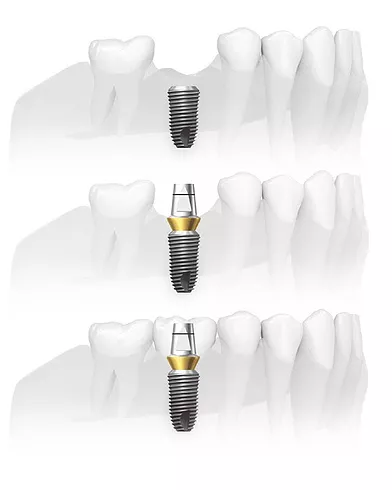 Этапы имплантации и протезирования на имплантатах