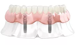 Съемные протезы на имплантатах