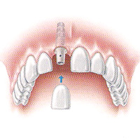 имплантация зубов в Химках